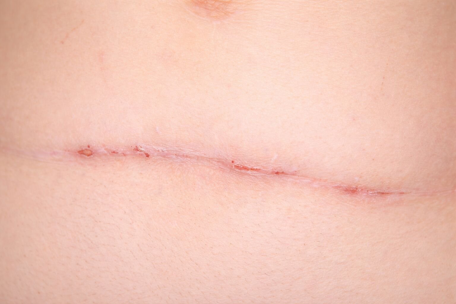 Cicatriz em pele após cirurgia abdominal
