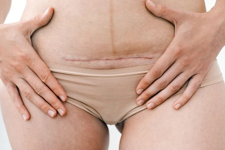 Cicatriz em abdômen feminino após cirurgia
